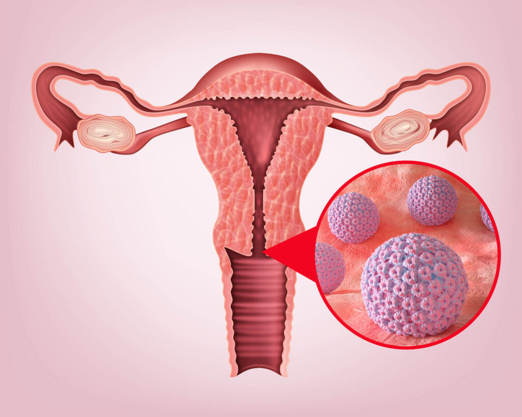 Human papillomavirus in cervix