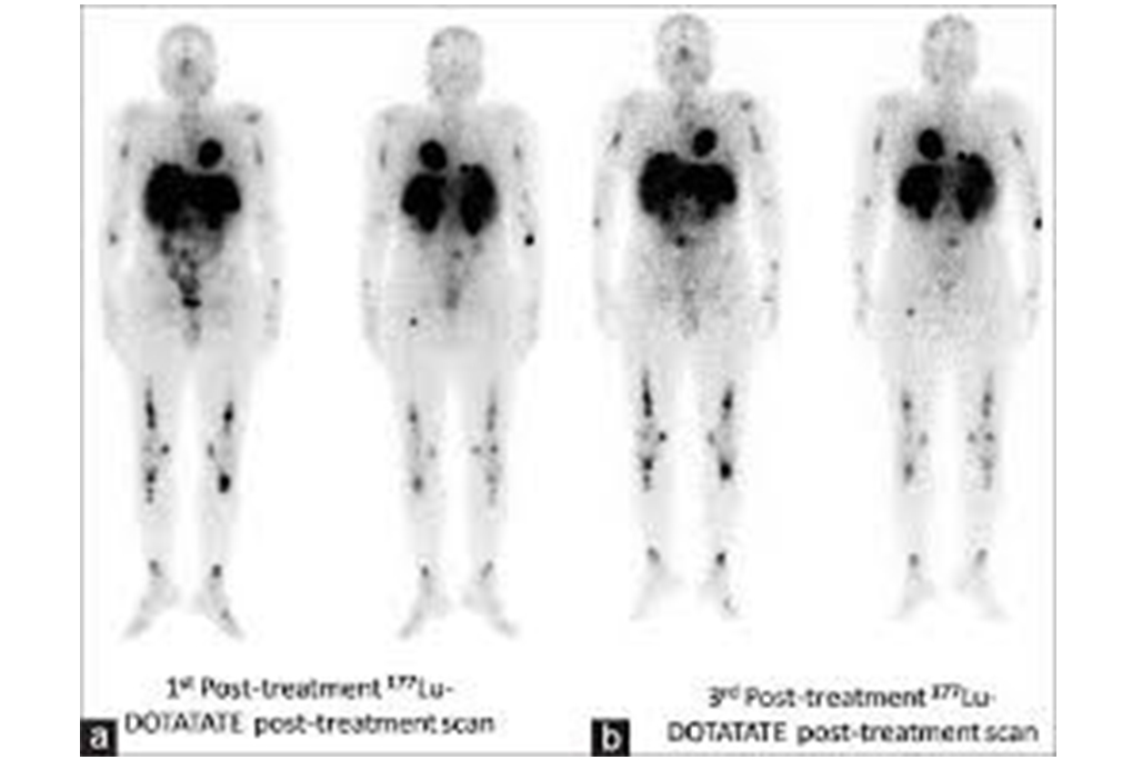 Leutetium-DOTATATE for Neuroendocrine Tumors
