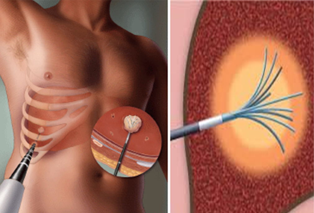 Radiofrequency Ablation (RFA)