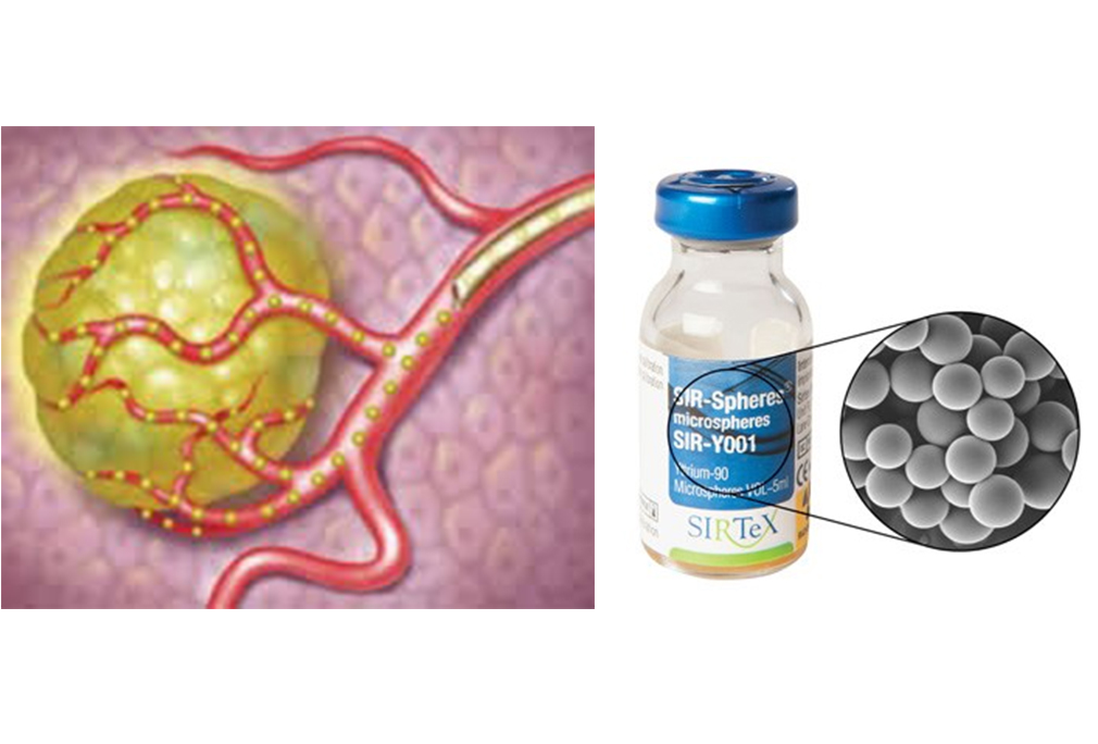 Selective Internal Radiation Therapy (SIRT)