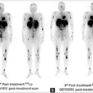 Leutetium-DOTATATE for Neuroendocrine Tumors