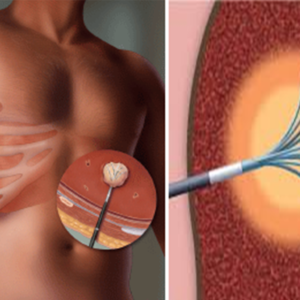 Radiofrequency Ablation (RFA)