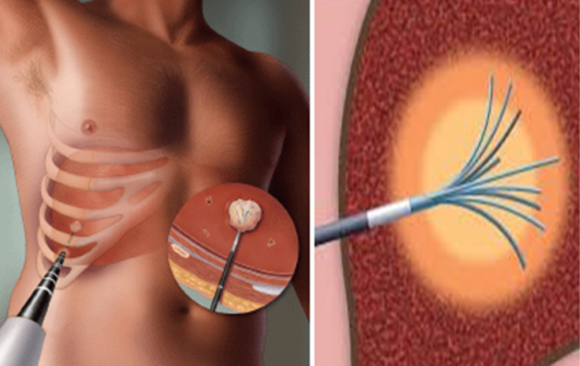 Radiofrequency Ablation (RFA)