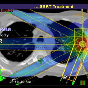 Stereotactic Body Radiation Therapy (SBRT)