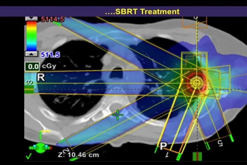 Stereotactic Body Radiation Therapy (SBRT)