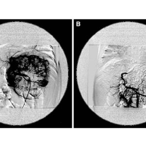 Transarterial Chemo-Embolization (TACE)