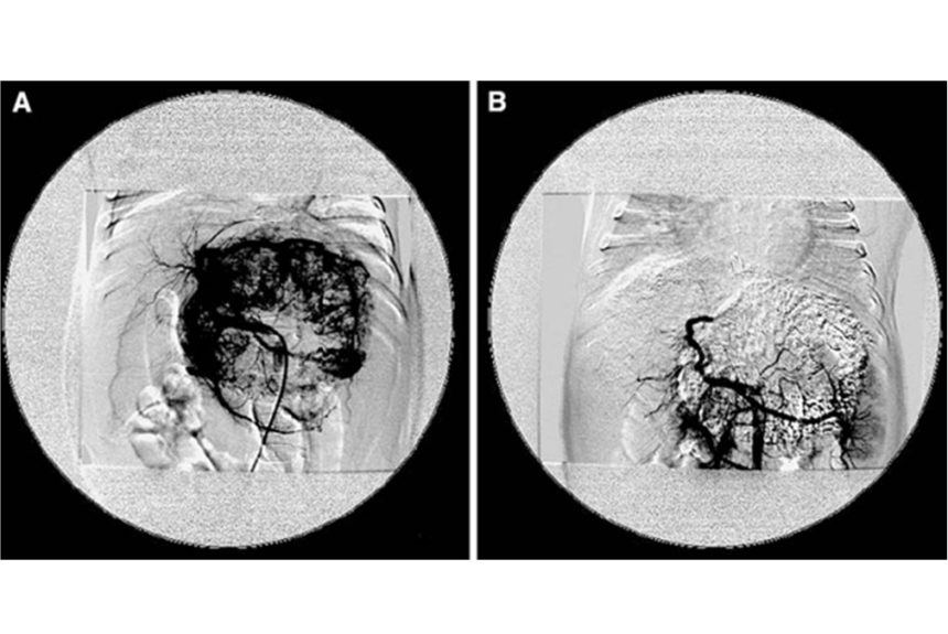 Transarterial Chemo-Embolization (TACE)